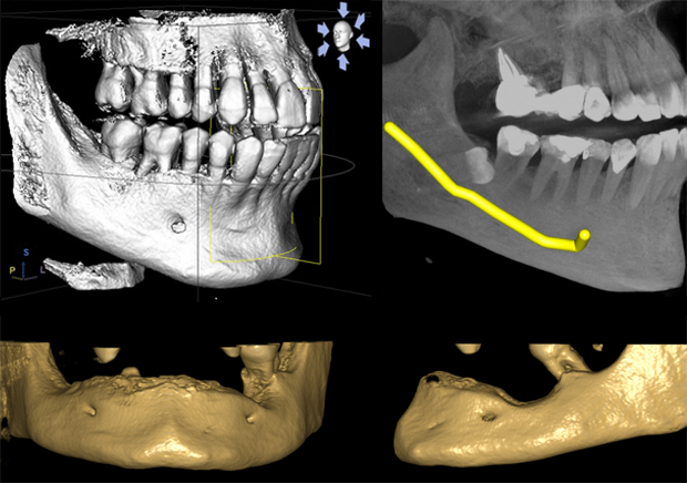 cbct-aktinografia