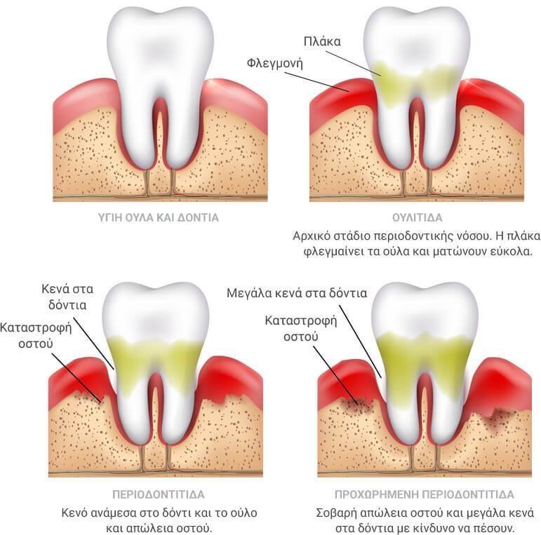 Περιοδοντίτιδα-hellinicondental