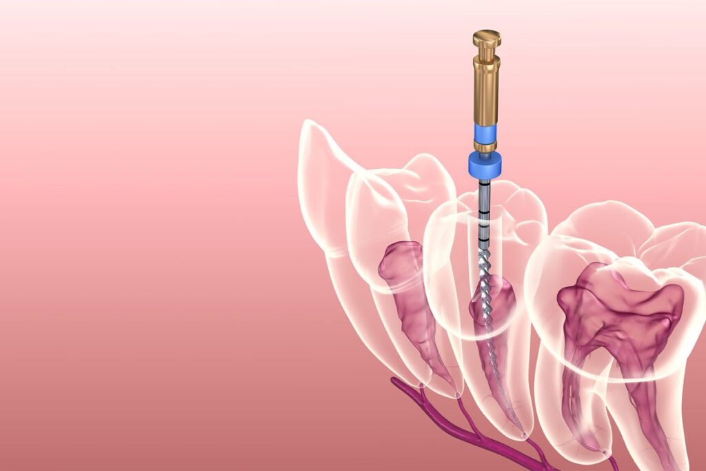 Απονεύρωση Δοντιού: Πονάει; Τι να Περιμένετε | Hellinicon